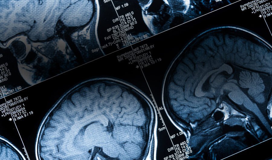 British Neuro-oncology Society